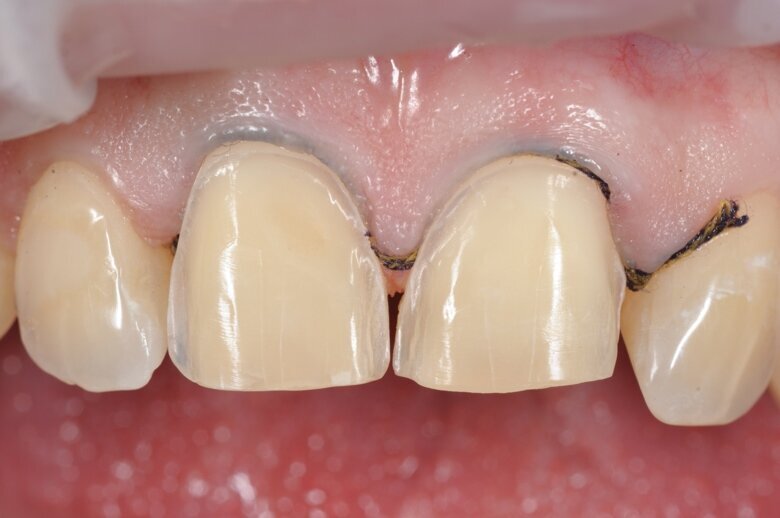 Fig. 5 Definitive preparation (frontal).