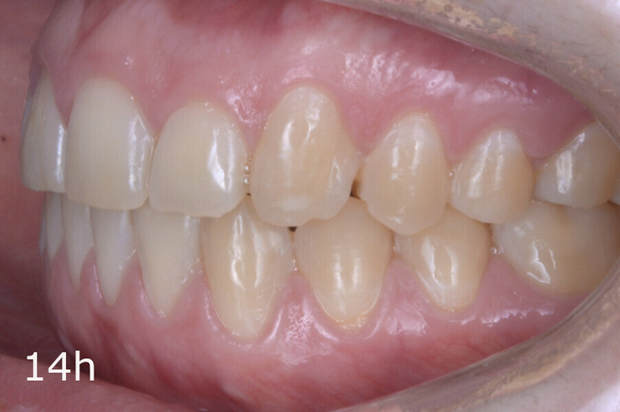 Figs. 14a–h: Intra-oral comparison of the situation (a, d, e & h) before and (b, c, f & g) after treatment.