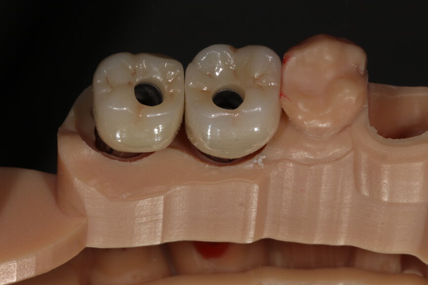 Fig. 12: Crowns on printed model.