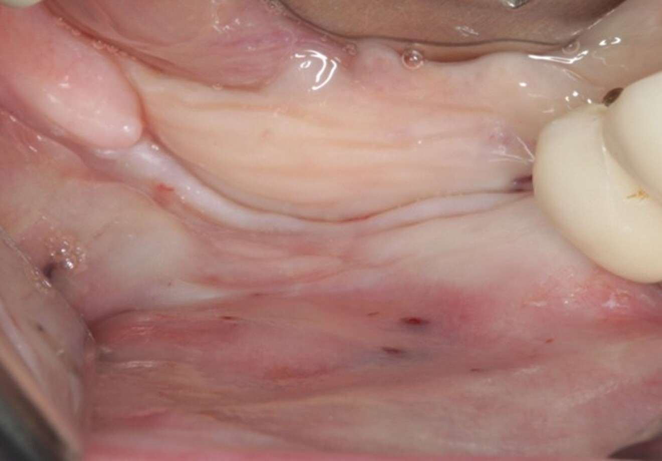 Clinical situation after vertical bone augmentation using the tunnel technique in the posterior mandible.