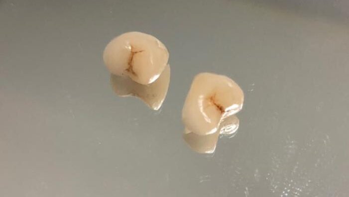 Substitution of two destructive caries with ceramic CAD/CAM crowns in one visit