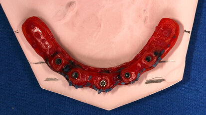 Fig. 2. Barra de Duralay® OSU, modelo rígido donde se fabrica la barra y barra metálica colada. Fig. 2. Barra de Duralay® OSU, modelo rígido donde se fabrica la barra y barra metálica colada.