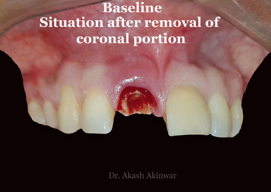 Fg 8: Baseline after the removal  of mobile crown fragment