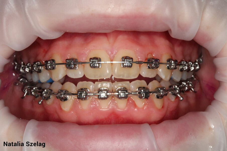Fig. 3c: After Guided Biofilm Therapy