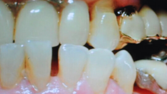 Non solo batteri ma trauma occlusale all’origine della malattia parodontale