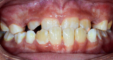 Early correction of anterior cross bite