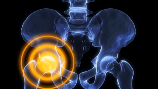 Rare fratture atipiche del femore. Un effetto di classe dei bisfosfonati