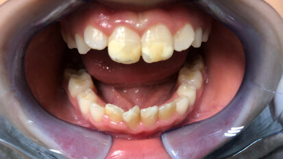 Curasept Biosmalto Mousse: wspomaga leczenie ortodontyczne pacjentów z defektami szkliwa i MIH