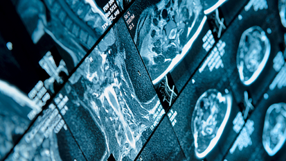 AO Orlando preview: Sinus floor bone graft