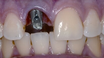 Die rot-weiße Ästhetik im Frontzahnbereich