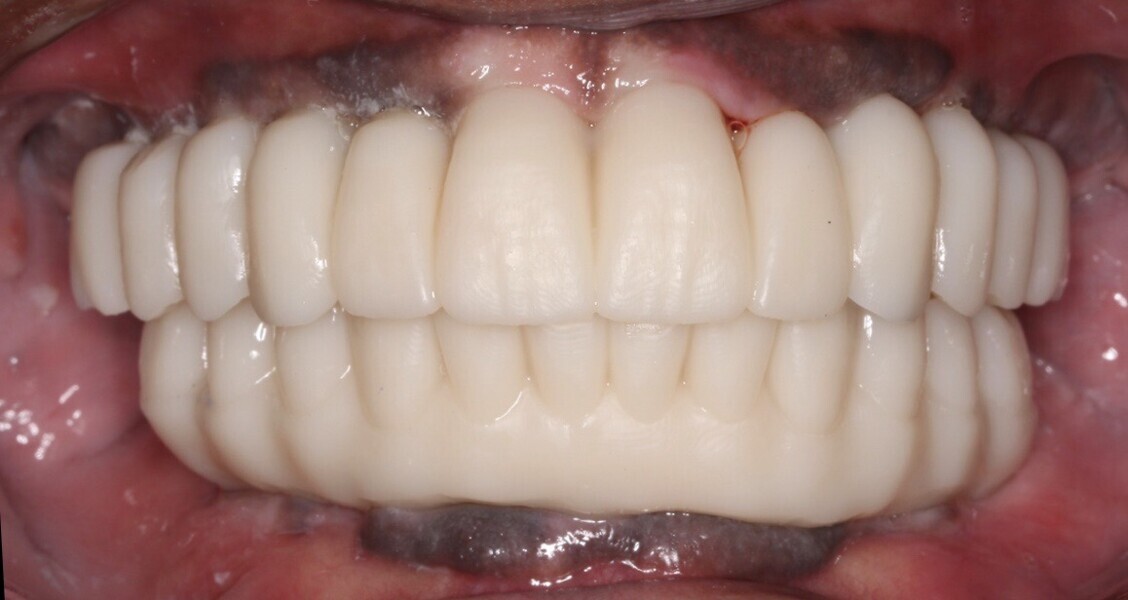 Fig. 21: Frontal view of the try-in Flexcera Smile final prostheses duplicates to assess function and aesthetics.