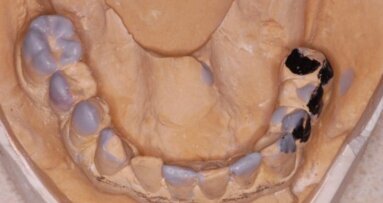 Implantoprotetyczna rehabilitacja braków skrzydłowych z pełną odbudową estetyczną