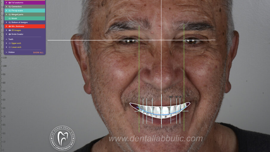 Slika 3 Definitivni dizajn privremenog mosta u Exocad – DentalCAD softveru (Zubna laboratorija Bulić)