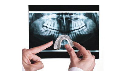 Ακούσιες μεταβολές στη σύγκλειση μετά τη χρήση ναρθήκων βρυγμού