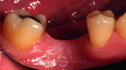 Implant restoration with CEREC