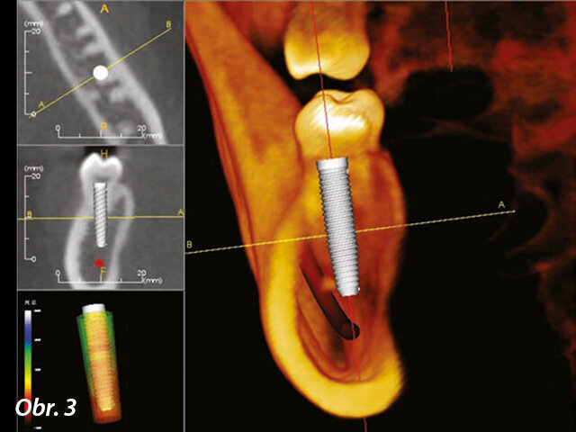 CBCT sken (i-CAT), jak je viditelný v softwaru pro 3D plánování (InVivoDental) (obrázek publikován se svolením Anatomage)