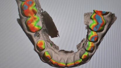 Skanowanie z poziomu implantu – część 1