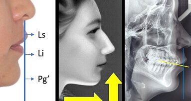 El control vertical del sector posterior mandibular