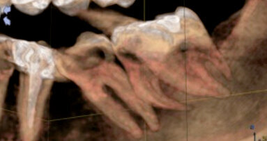 CBCT nel trattamento di un secondo e terzo molare mandibolare fusi