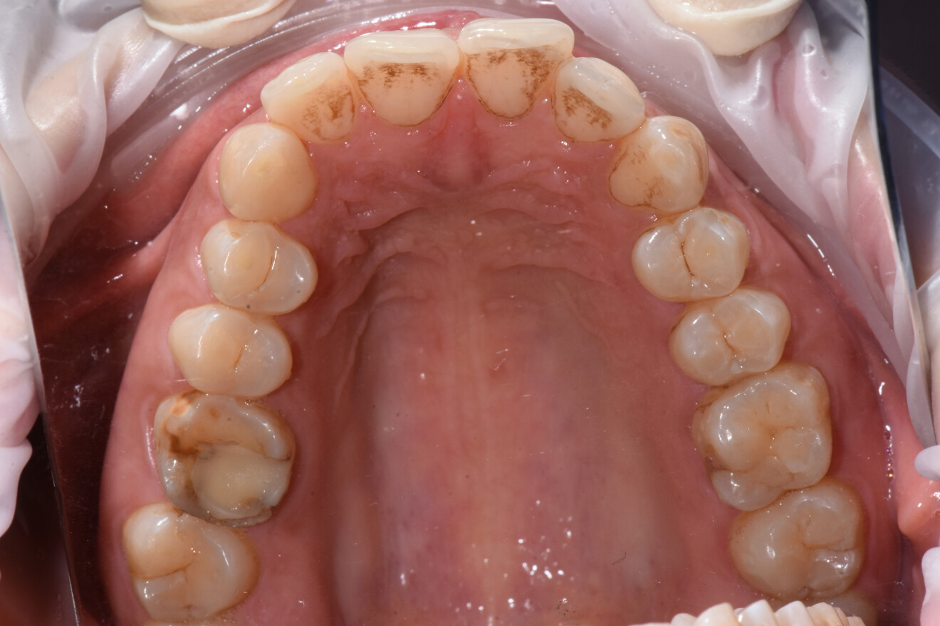 Figg. 1-3 - Situazione iniziale arcata superiore e inferiore, foto intraorali.