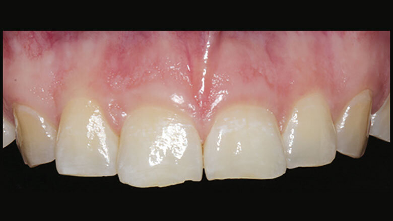 Figure 2: Loss of tooth length and palatal enamel