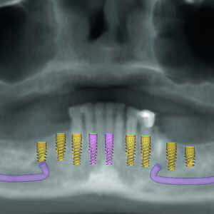 Fig-4-Présentation-du-traitement-de-l’arcade-mandibulaire-300x300-