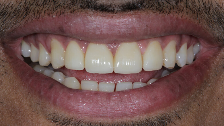 Designing smiles and Changing lives with Porcelain Laminate Veneers