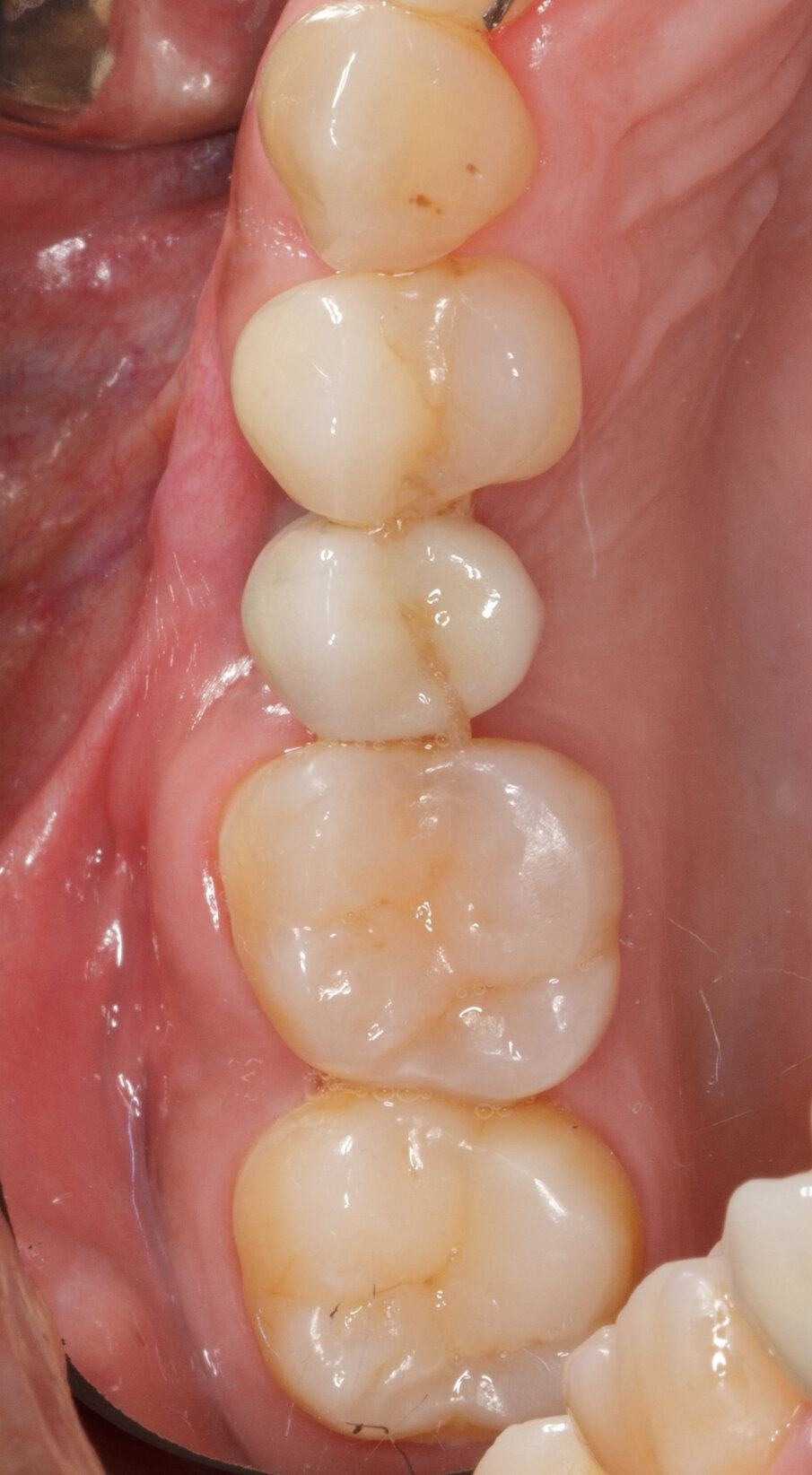 Fig. 29 - Controllo clinico a 6 anni.