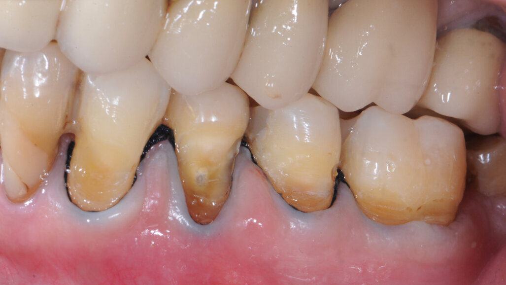 Caries radiculaires – Difficultés et recommandations pour la pratique