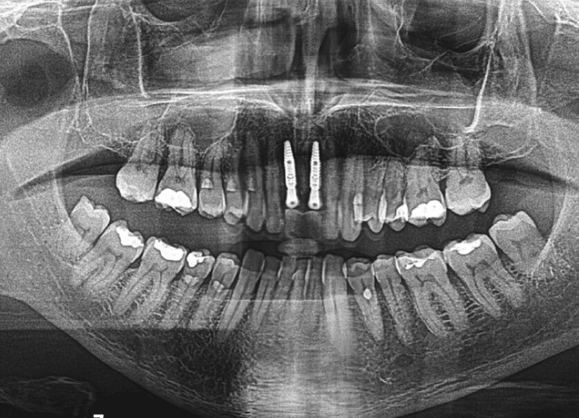 Slika 7. Postoperativni ortopantomogram: pravilan položaj implantata 11 i 21
