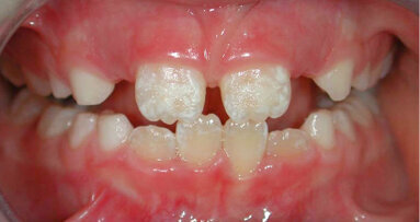 Absence of breastfeeding may predispose  children to enamel defects