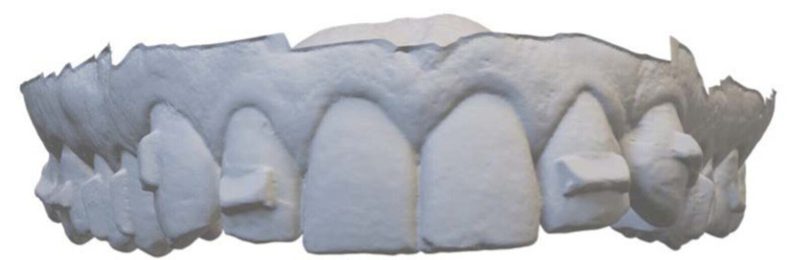 Figs. 7a & b: Post-bonding scan of the Clarity Precision Grip Attachments in the case demonstrated.