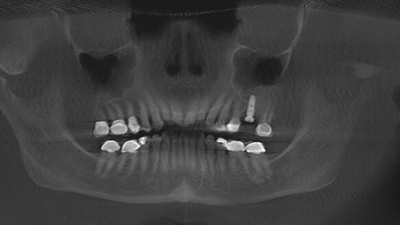 The evolution of sinus lift techniques