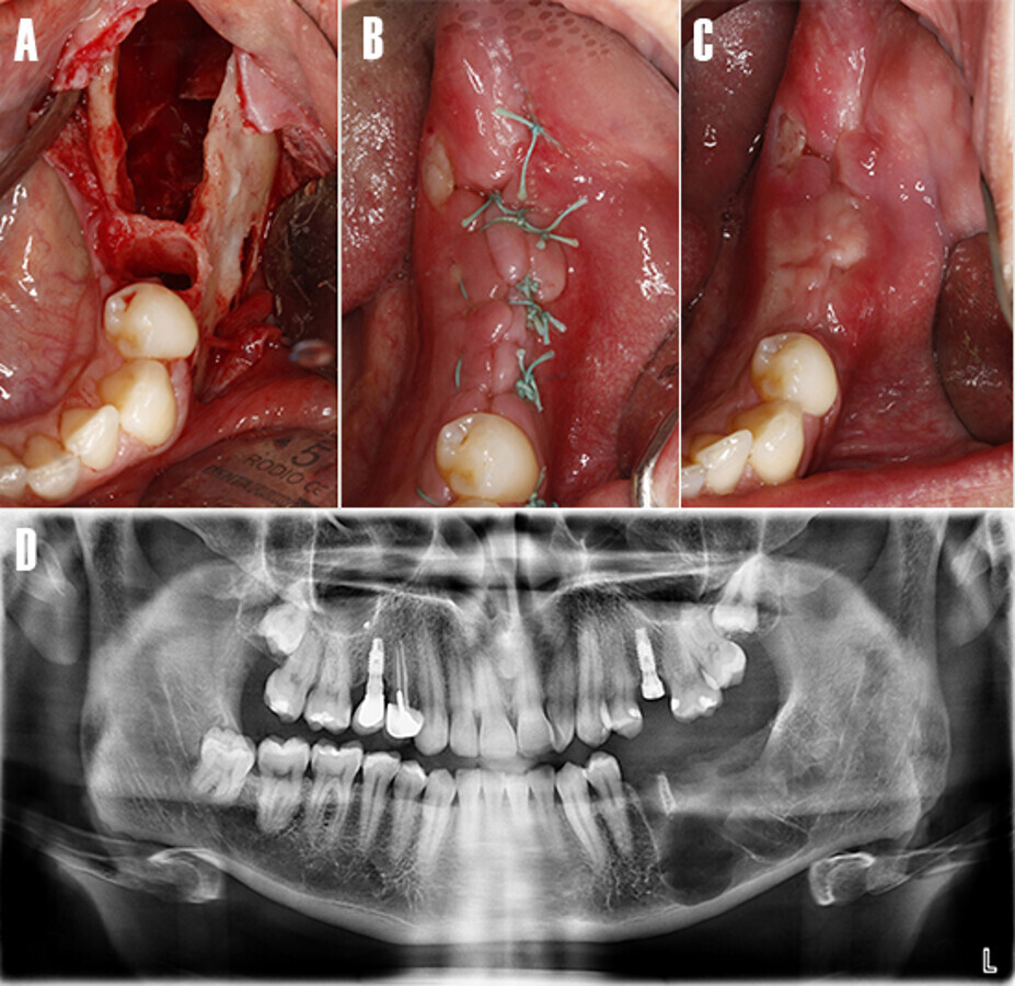 Figura 8. ExtracciÃ³n de los dientes impactados. Imagen intraoral - vista oclusal. A) Cavidad osteolÃ­tica tras la enucleaciÃ³n de la patologÃ­a y extracciÃ³n de los dientes impactados . B) Se realiza la sutura con puntos interrumpidos y seda no reabsorbible. C) CicatrizaciÃ³n a la semana postoperatoria. D) OrtopantomografÃ­a postoperatoria inmediata.
