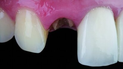 Les reconstitutions corono-radiculaires : d’hier à aujourd’hui