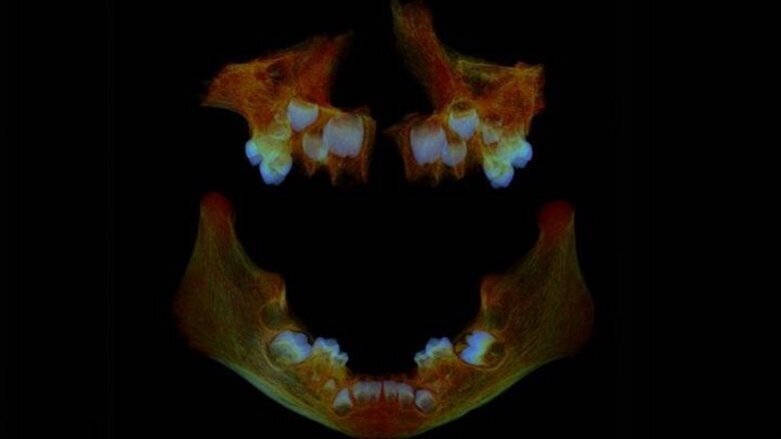 Anglo-Saxon teeth could help identify modern health issues, study finds