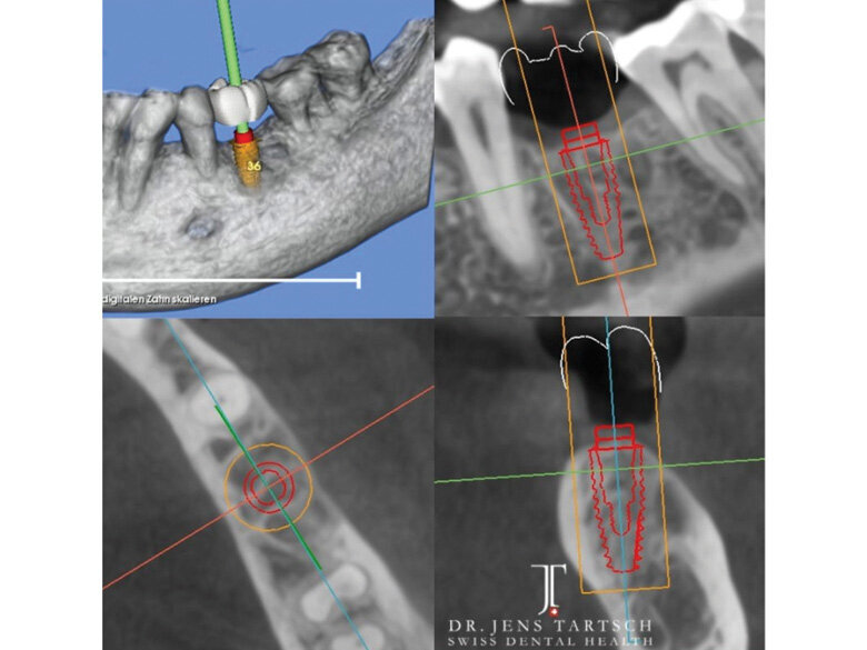Fig. 1: Diagnostic 3-D treatment planning. Implant dimension and position with SMOP guided-surgery system. (Photo: Jens Tartsch, DMD)