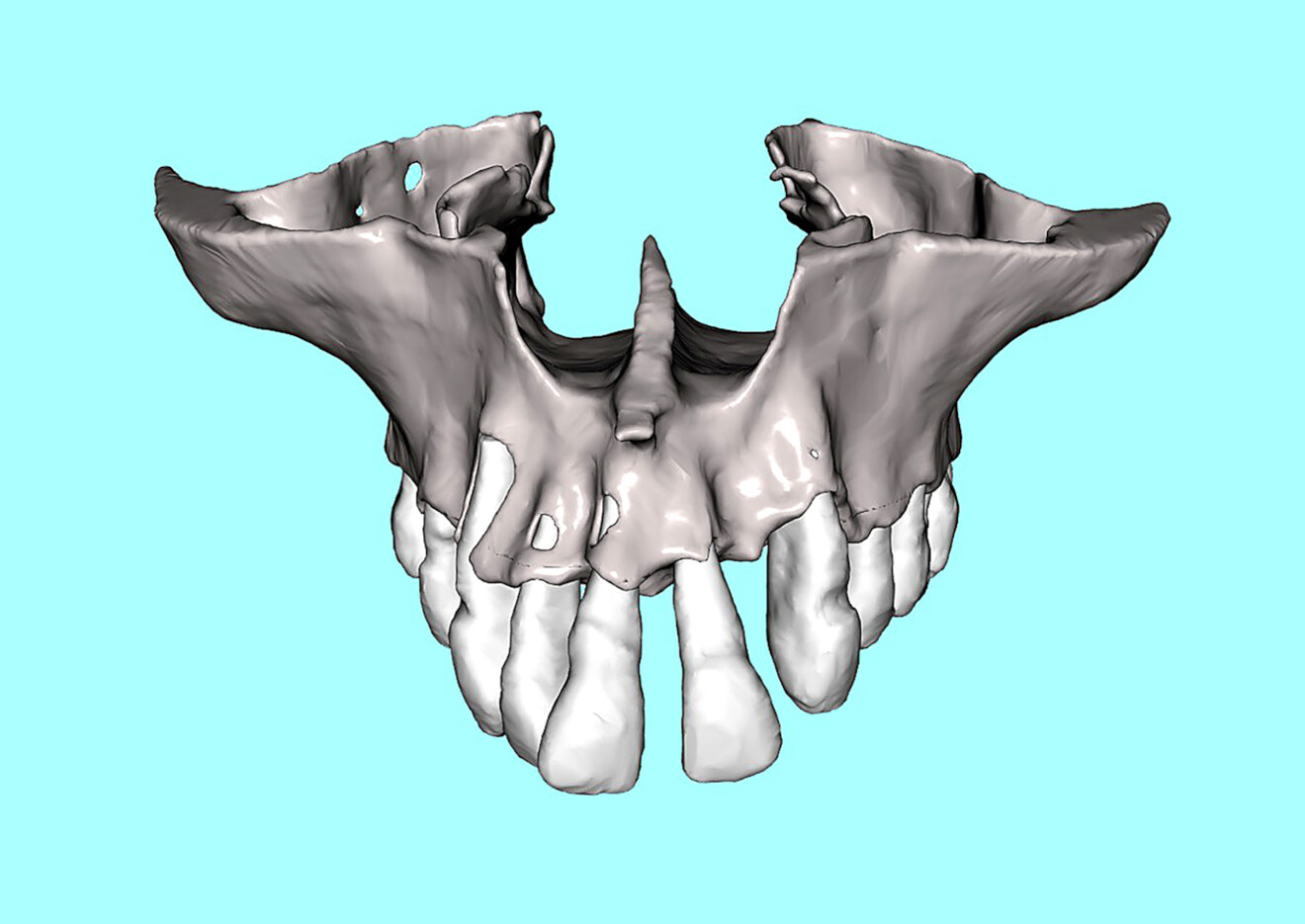 Fig. 4a: 3D volumetric reconstruction of the maxilla. Extent of the bone loss and spacing of the anterior teeth.