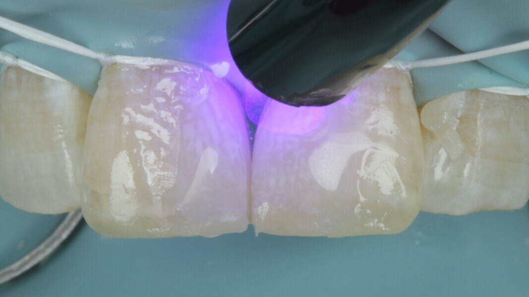 Fig 19. A water soluble medium is applied and light cured under that to eliminate the Oxygen Inhibited Layer.