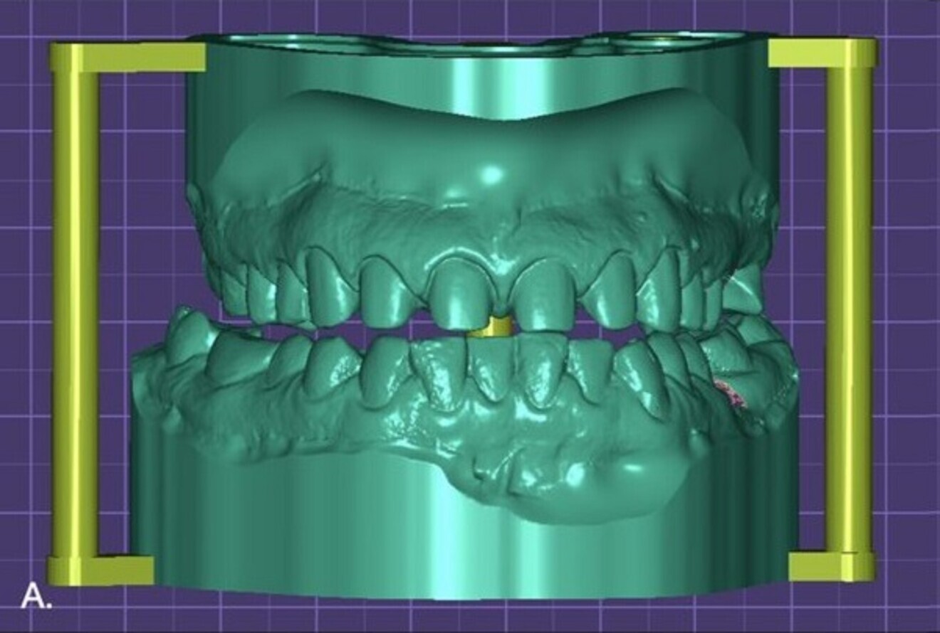 Fig. 5a: Preparations on the exocad model.