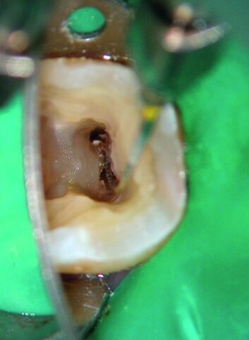 Fig. 6: Ultrasonically energised K-file used to prepare an isthmus under the operating microscope.