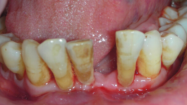 L’odontoiatria a misura  del paziente con patologia osteometabolica a rischio di osteonecrosi delle ossa mascellari da farmaci