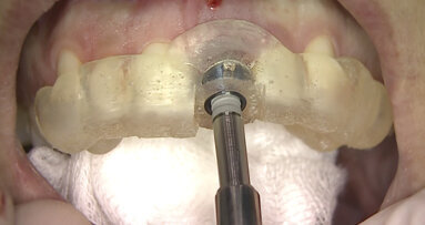 Il razionale del posizionamento implantare tridimensionale protesicamente guidato nei settori estetici