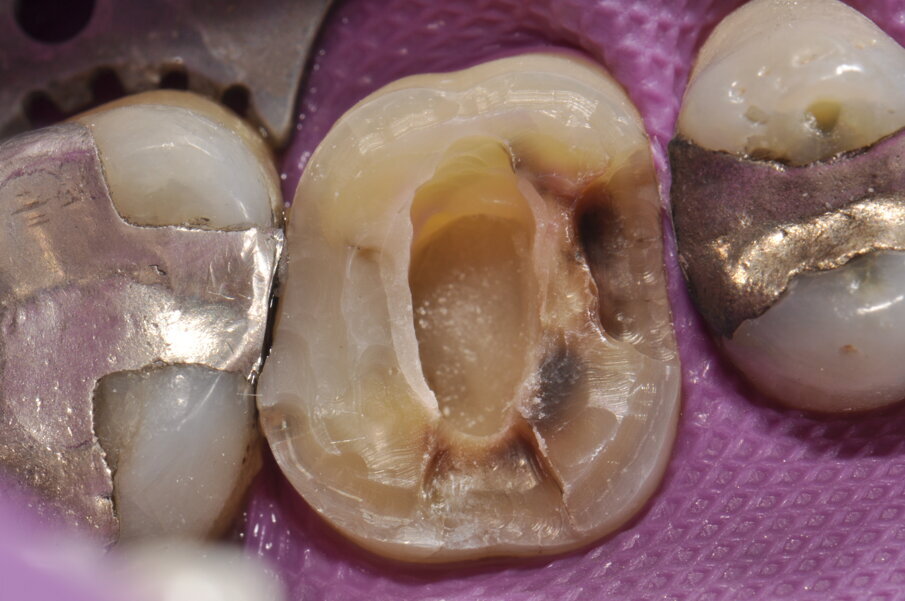 Fig. 4: Aplicación de una capa de cemento de restauración de ionómero de vidrio para crear un forro cavitario con liberación de fluoruro.