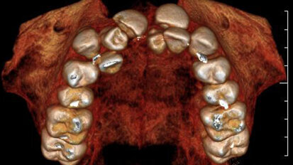 Clinical and diagnostic advantages using the PreXion 3-D cone-beam imaging system Clinical and diagnostic advantages using the PreXion 3-D cone-beam imaging system