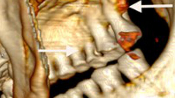 Première visite d’Ötzi chez le dentiste