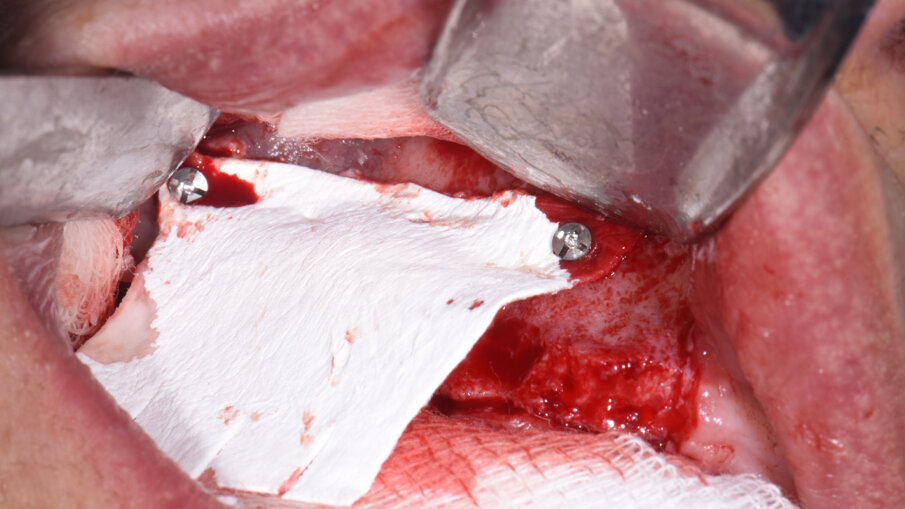 Obr. 6: Zajištění kolagenní membrány pomocí minišroubků.