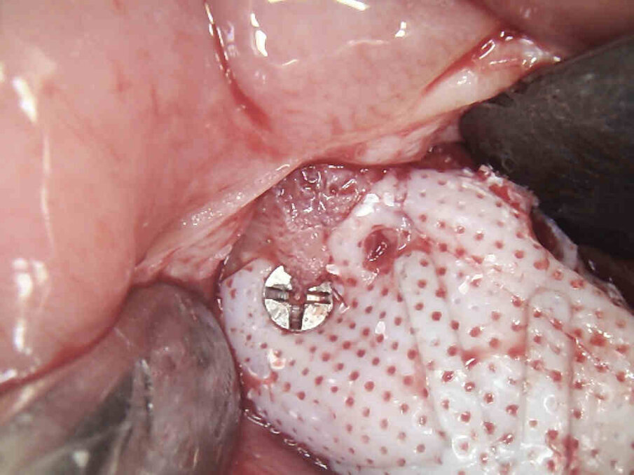 Figg. 11, 12_Si evidenzia formazione di osso al di sopra della membrana e si procede alla rimozione della stessa.