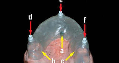 TRIPODE – Un nouveau protocole pour la mise en charge immédiate de prothèses complètes sur implants