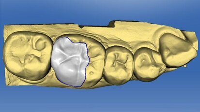 The digitized occlusion: Using something old with something new
